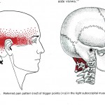 Triggerpunkt, m suboccipitale