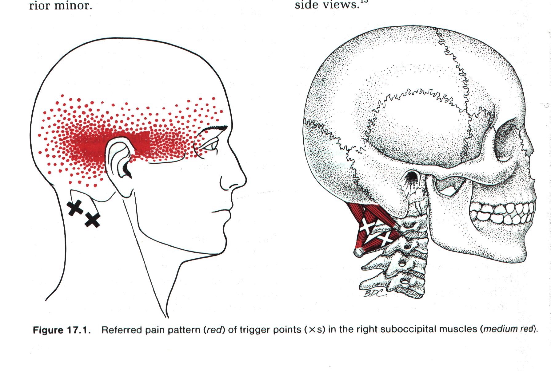 Между затылком. Миофасциальные триггерные точки шея голова. Подзатылочные мышцы триггерные точки. Ременная мышца триггерные точки. Триггерные точки мышц головы.